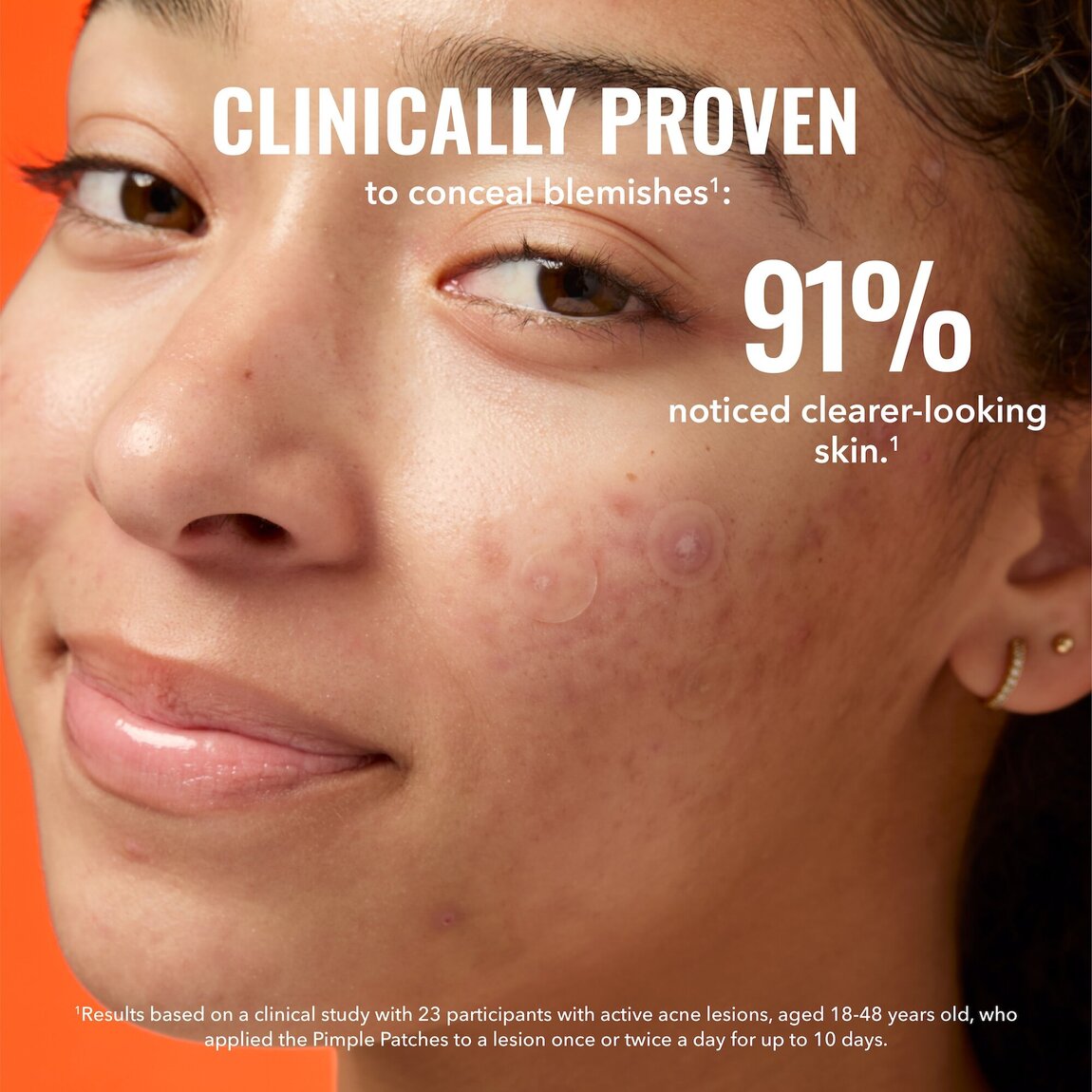 pimple-patches-z4 zb_p.jpg